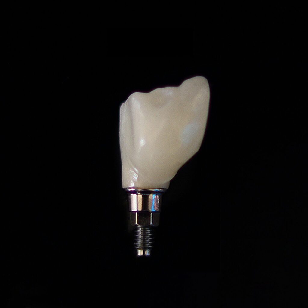 Dental Implants in Merida Mexico